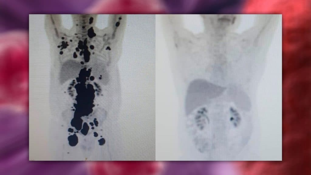 Tratamento-cancer-01-1024x576