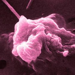 Nova forma de detecção do câncer no pâncreas é descoberta