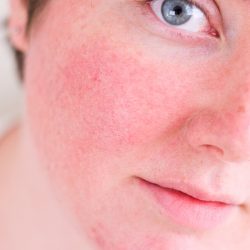 Como aliviar os sintomas da pele com rosácea