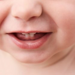 Sapinho em bebês é comum até os dois meses de idade