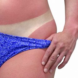 Como tratar queimaduras de pele provocadas pelo Sol