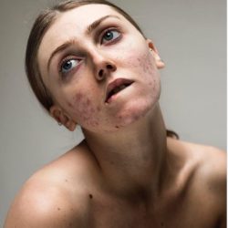 Movimento estimula mulheres com acne a se aceitarem