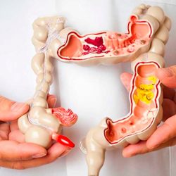 Sintomas de câncer de intestino podem variar de acordo com a localização do tumor