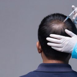 Recuperação capilar  com ozonioterapia Ozonioterapia contra  queda de cabelo e calvície