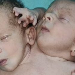 Gêmeos siameses nasceram com duas cabeças, três braços e dois corações na Índia