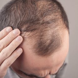 Medicamento para artrite poderá ser usado no tratamento de alopecia