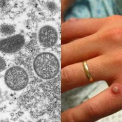 Mulher de Uruguaiana é o terceiro caso confirmado de varíola do macaco no RS