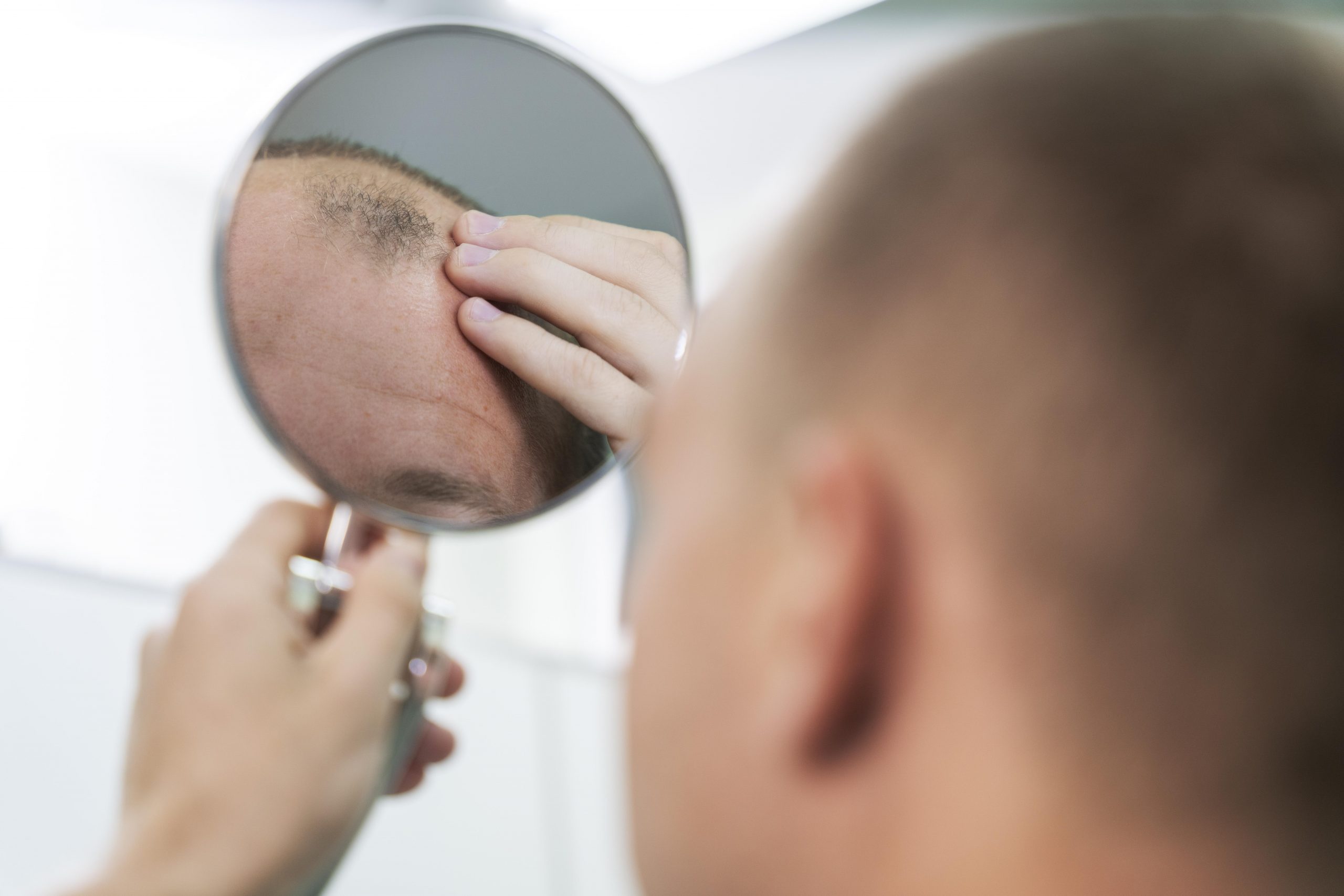 adult-male-having-balding-problems