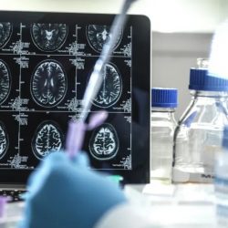 Novo tratamento inibe crescimento de células de tumores cerebrais, diz estudo