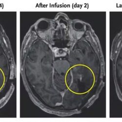 Tumor de paciente com câncer no cérebro regride dias após terapia com células CAR-T, mostra estudo